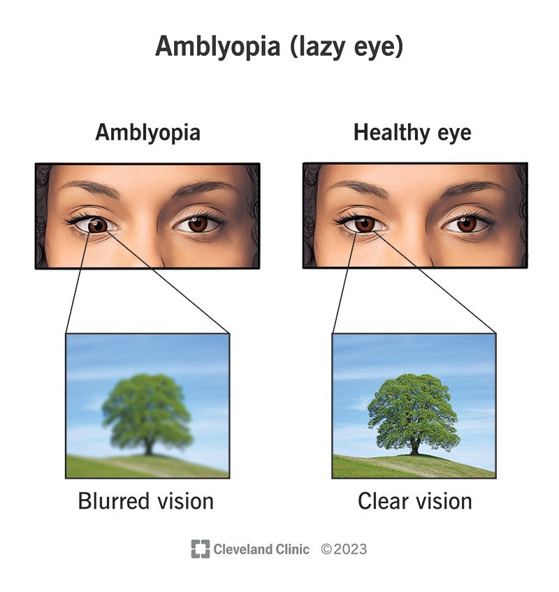 Amblyopia